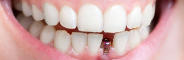 Wstawianie implantu zębowego